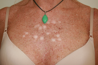 Skin Cancer Excision Scarring