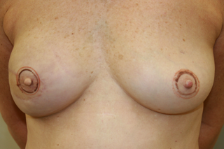 Breast Markup