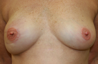 Breast After